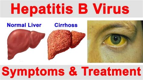 hepatit b belirtileri ne zaman ortaya çıkar
